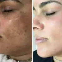 کرم معجزه vip اصلی سفید کننده دائم پوست و لکه بر