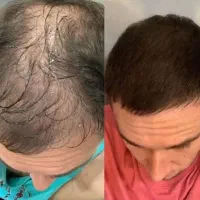 نلوژن با جدید ترین متد میشه بمب پرپشتی موهات