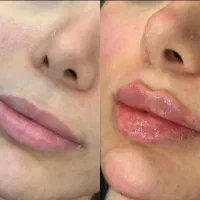 تزریق ژل بوتاکس، آنزیم ،مزوتراپی و..