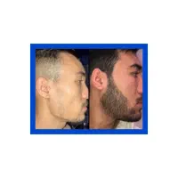 کاشت ریش و مو ممنوع شد