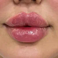 جشنواره ویژه فیلر پی ارپی مزوبوتاکس با بهترین فرم|خدمات زیبایی و سلامت|تبریز, |دیوار