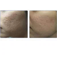 ریموتتوروشن کردن نواحی تیره درمان لک|خدمات آرایشگری و زیبایی|قم, باجک دو|دیوار