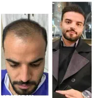 کاشت مو و ابرو|خدمات آرایشگری و زیبایی|بوشهر, |دیوار