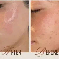 فشیال تخصصی+درماپلینگ+ اصلاح ابرو