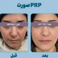 پروتوکین تراپی تخفیف ویژه روز دانشجو|خدمات آرایشگری و زیبایی|زاهدان, |دیوار