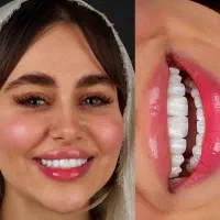 ایمپلنت اقساطی دندانپزشکی لمینیت