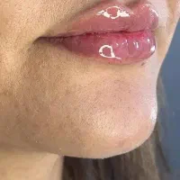 تزریق ژل و بوتاکس