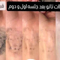 رفع تاتوروشن‌سازی زیربغل کربن تراپی مطب دکترموسوی|خدمات آرایشگری و زیبایی|تهران, فردوس|دیوار