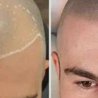 میکروبلیدینگ و اسکالپ سر آقایان|خدمات زیبایی و سلامت|اهواز, کوی ملی راه|دیوار