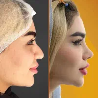 جشنواره جراحی و عمل بینی در کرج|خدمات آرایشگری و زیبایی|چهارباغ, |دیوار