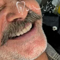 دندان مصنوعی،روکش،ایمپلنت دندانپزشکی دکتر نقوی