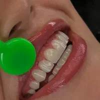 کامپوزیت ، لیرینگ لبه شیشه ای ، لمینت ،دندانپزشکی