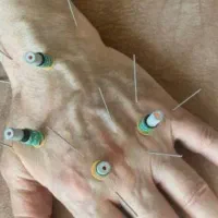 حجامت طبی سوزنی امبدینگ زالودرمانی زگیل تناسلیhpv