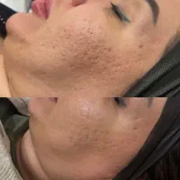 مدل پاکسازی صورت و فیشیال فوری فقط هزینه مواد|خدمات آرایشگری و زیبایی|اهواز, پردیس دو|دیوار