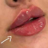 پکیج تخفیفی تزریق ژل و بوتاکس و مزوژل و آموزش