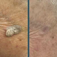 فریز زگیل ( بالوکە )|خدمات آرایشگری و زیبایی|بوکان, |دیوار