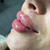 تزریق ژل و‌ بوتاکس چشم گربه ای