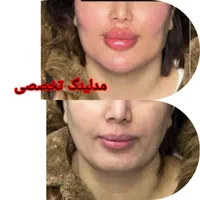 ساکشن غبغب وشکم. کاشت ابرو .|خدمات آرایشگری و زیبایی|پرند, |دیوار