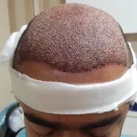 کاشت مو فقط و فقط با ۱۰تومان