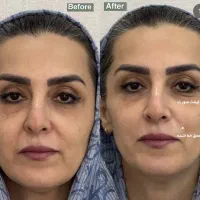 هایفو صورت و واژینال با دقت هوش مصنوعی افر تافردا|خدمات آرایشگری و زیبایی|مشهد, آزادشهر|دیوار