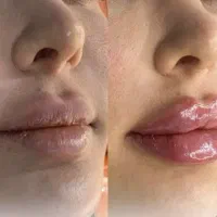 تخفیفات یلدا لاغری ، فیلر لب،بوتاکس وجوانسازی صورت