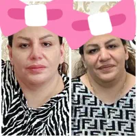 عمل بینی گوشتی بصورت تخصصی