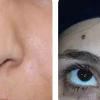 لیزرخال وزگیل منگوله های گوشتی بدون درد|پزشکی|دورود, |دیوار