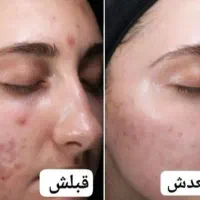 کرم وی ای پی اصل صدرصد تضمینی و بدون بازگشت|آرایشی، بهداشتی، درمانی|یاسوج, |دیوار