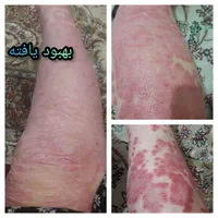 درمان پیسی / پسوریازیس/ مشکلات پوستی و ایمنی|آرایشی، بهداشتی، درمانی|مشهد, شهرک رازی (شهرک غرب)|دیوار