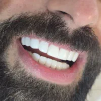 کامپوزیت.لمینت.دندانپزشکی