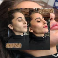 جشنواره مدلینگ ۱۰ سی سی امروز۳۳۰۰فیلر لب لیفت ابرو