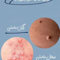 رفع دائمی زگیل و تبخال تناسلی|آرایشی، بهداشتی، درمانی|قزوین, |دیوار