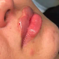 لب‌روسی فیلر و ژل‌صورت ، 350هزار، پیرسینگ و تتو|خدمات آرایشگری و زیبایی|پرند, فاز ۲|دیوار