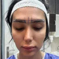 کاشت ابرومومزوتراپی تزریق ژل فیلربوتاکس هایفوتراپی