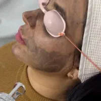 مرکز تخصصی ریمو تتو و کربن تراپی