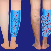 درمان واریس