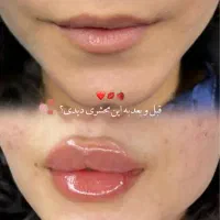 جشنواره تزریق ژل و بوتاکس