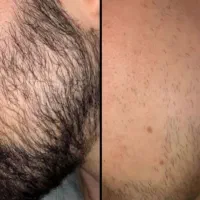 ریزش و کم پشتی ریش و مو