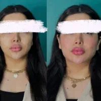 آموزش و خدمات ژل و بوتاکس هر سیسی 590در مطب تخصصی|خدمات آرایشگری و زیبایی|اصفهان, رکن الدوله شرقی|دیوار