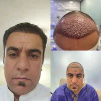 کاشت مو  تخصصی  تخفیف ۲۰درصدی مارو از دست ندهید|خدمات آرایشگری و زیبایی|اهواز, کیانپارس |دیوار