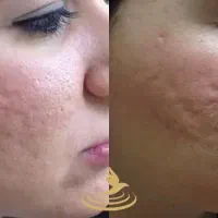 از بین بردن جای جوش و لک ،به روش مزونیدلینگ|خدمات آرایشگری و زیبایی|شیراز, معالی‌آباد|دیوار