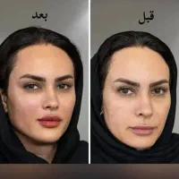 آف ویژه فیلر فول فسی  و مدلینگ صورت فقط ۳۹۰۰|خدمات آرایشگری و زیبایی|کرج, گوهردشت|دیوار
