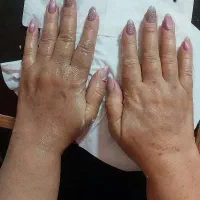 تزریق ژل و بوتاکس