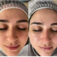 فیشال تخصصی پوست|خدمات آرایشگری و زیبایی|نوشهر, |دیوار