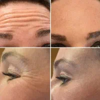 بوتاکس کامل صورت تضمینی