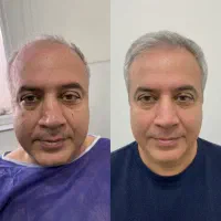 کاشت مو و ابرو VIP کلینیک سپهر دکتر علی وفائی