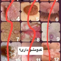 بیماری های ویروسی زگیل و تبخال|خدمات آرایشگری و زیبایی|خمینی‌شهر, |دیوار