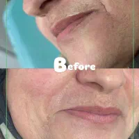 کانتورینگ فول فیس ، بوتاکس،لیزر ، ژل وفیلر ،فیشال|خدمات آرایشگری و زیبایی|فردیس, شهرک ۱۱۰|دیوار