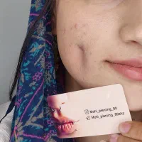 خدمات چال لپ هیدن .پیرسینگ .میکرودرمال
