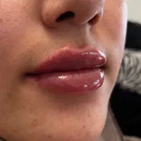 ژل لب،زاویه سازی،فیلر چانه،فول فیس|خدمات آرایشگری و زیبایی|مشهد, عسگریه|دیوار